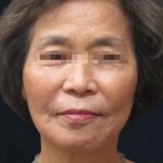 Facelift Before & After Patient #11664