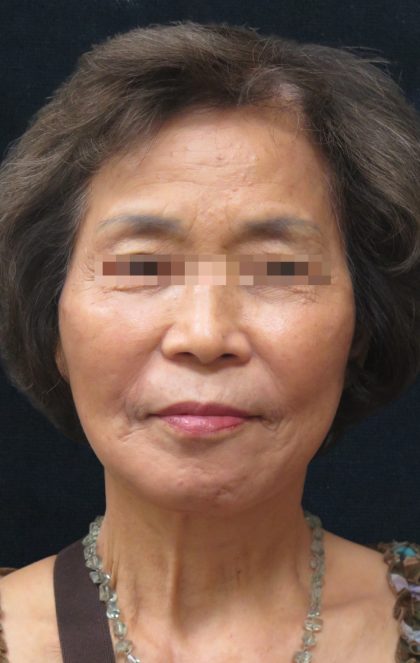 Facelift Before & After Patient #11664