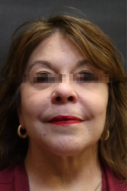 Facelift Before & After Patient #11663