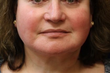 Facelift Before & After Patient #11667
