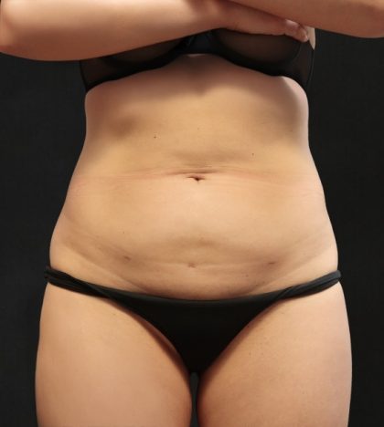Liposuction Before & After Patient #11543