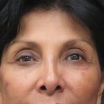 Browlift Before & After Patient #11766