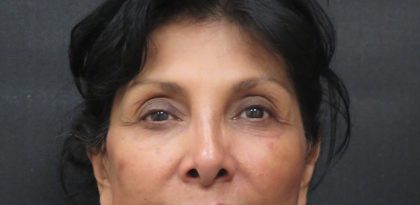 Browlift Before & After Patient #11766