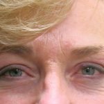 Browlift Before & After Patient #11767