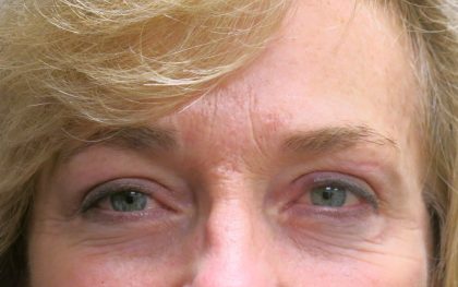 Browlift Before & After Patient #11767