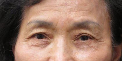 Browlift Before & After Patient #11769