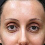 Browlift Before & After Patient #11771