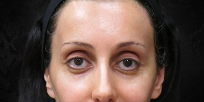Browlift Before & After Patient #11771
