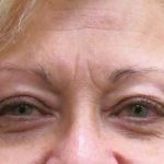 Browlift Before & After Patient #11772