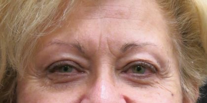 Browlift Before & After Patient #11772