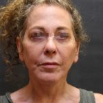 Levinelift Before & After Patient #11787
