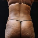 Liposuction Before & After Patient #11544