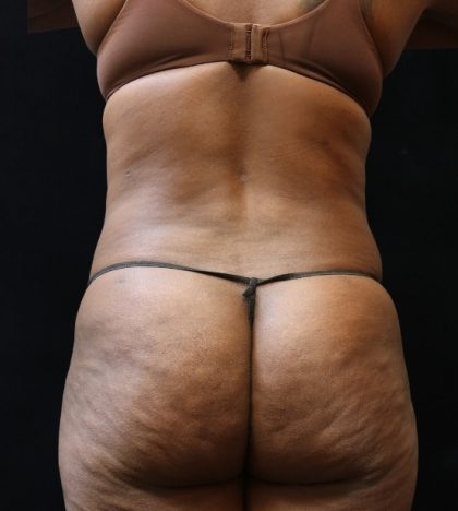 Liposuction Before & After Patient #11544