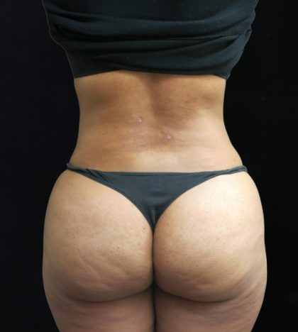 Liposuction Before & After Patient #11540