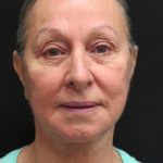 Levinelift Before & After Patient #11793