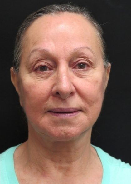 Levinelift Before & After Patient #11793
