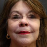 Levinelift Before & After Patient #11791