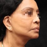 Levinelift Before & After Patient #11819