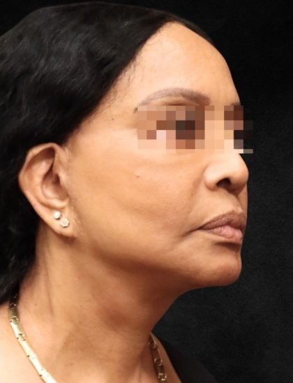 Levinelift Before & After Patient #11819