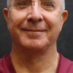 Levinelift Before & After Patient #11824