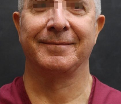 Levinelift Before & After Patient #11824