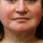 Levinelift Before & After Patient #11825