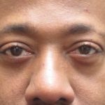 Eyelid Surgery Before & After Patient #11890