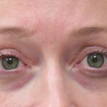 Eyelid Surgery Before & After Patient #11891