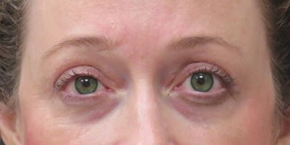 Eyelid Surgery Before & After Patient #11891