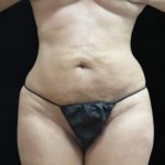Liposuction Before & After Patient #11545