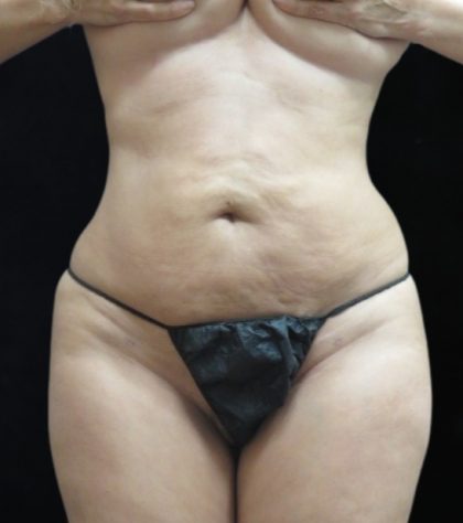 Liposuction Before & After Patient #11545