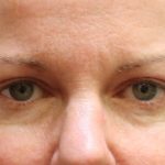 Eyelid Surgery Before & After Patient #11892