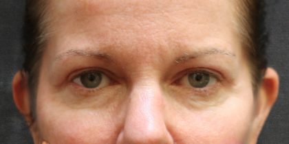 Eyelid Surgery Before & After Patient #11892