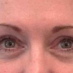 Eyelid Surgery Before & After Patient #11893
