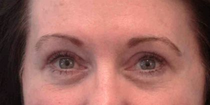 Eyelid Surgery Before & After Patient #11893