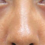 Eyelid Surgery Before & After Patient #11894