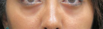 Eyelid Surgery Before & After Patient #11894