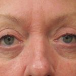 Eyelid Surgery Before & After Patient #11895