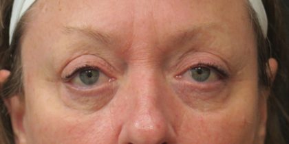 Eyelid Surgery Before & After Patient #11895