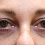 Eyelid Surgery Before & After Patient #11896