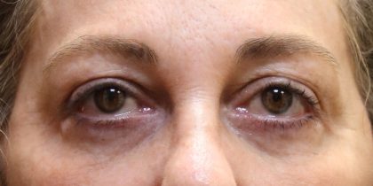 Eyelid Surgery Before & After Patient #11896