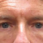 Eyelid Surgery Before & After Patient #11897