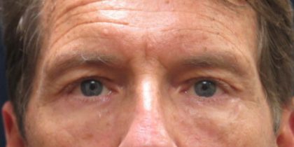 Eyelid Surgery Before & After Patient #11897