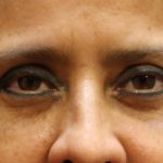 Eyelid Surgery Before & After Patient #11898