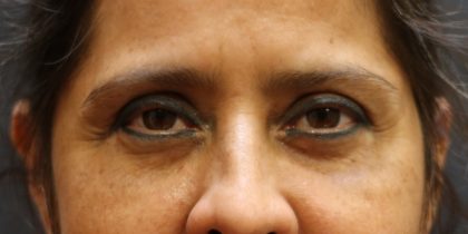 Eyelid Surgery Before & After Patient #11898
