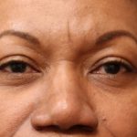 Eyelid Surgery Before & After Patient #11899
