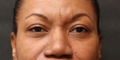 Eyelid Surgery Before & After Patient #11899