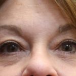 Eyelid Surgery Before & After Patient #11900