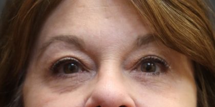 Eyelid Surgery Before & After Patient #11900