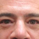 Eyelid Surgery Before & After Patient #11901